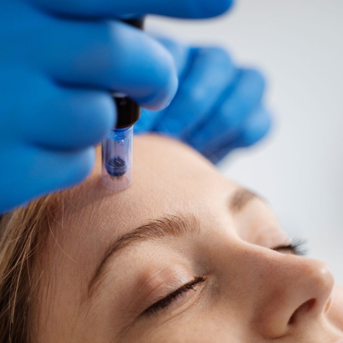 SkinPen® Microneedling: Ablauf, Hautreaktion und Nachpflege