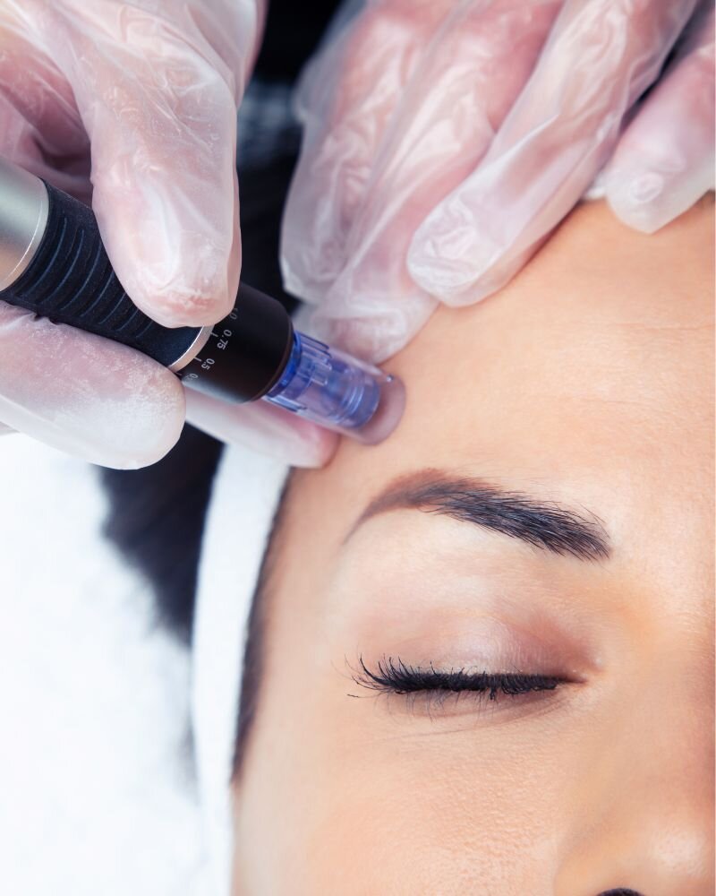SkinPen Microneedling bei Aesthetika Peponi